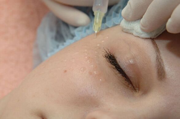 Mesotherapie ist eine Injektionsmethode zur Verjüngung der Gesichtshaut