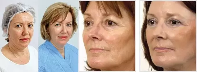 Das Ergebnis der Gesichtshautverjüngung mit Laser ist die Reduzierung von Falten