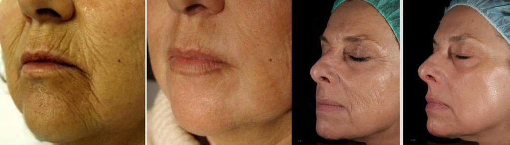 Gesichtshaut vor und nach der Laserverjüngung. 