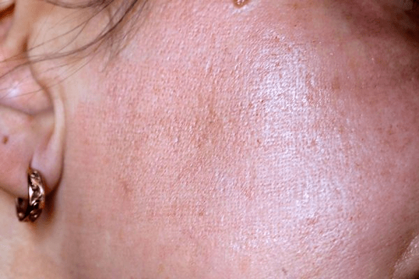 Hautrötung nach Laserbehandlung