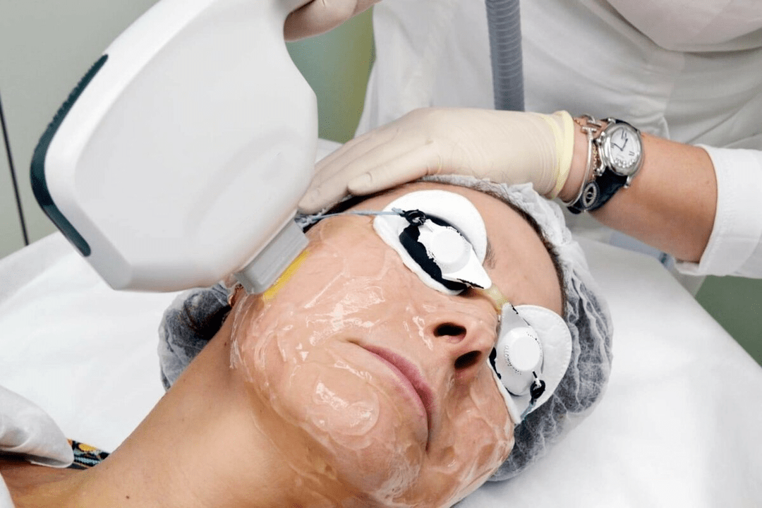 Laserbehandlung für die Gesichtshaut