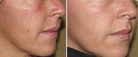 Gesicht vor und nach der Hautverjüngung